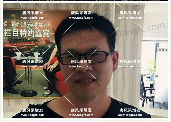 老師，我要你“脫”掉禿頂！