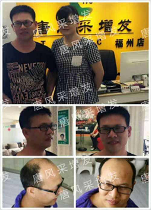 老師，我要你“脫”掉禿頂！