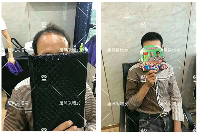 男士頭發(fā)稀少的原因是什么 唐風(fēng)采增發(fā)客戶案例