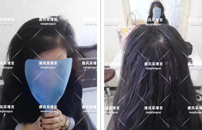 發(fā)際線高換什么發(fā)型都不好看 唐風(fēng)采增發(fā)客戶案例