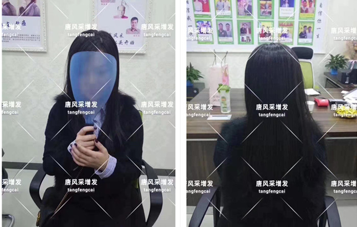 發(fā)際線高換什么發(fā)型都不好看 唐風(fēng)采增發(fā)客戶案例