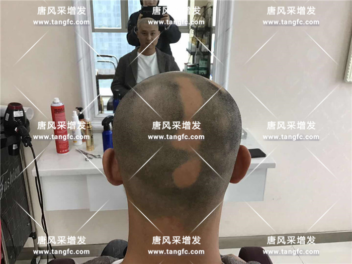 一夜之間形象全毀 趙先生脫發(fā)嚴(yán)重