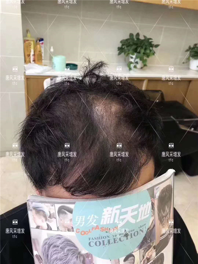 謝頂男人 在唐風采增發(fā)后