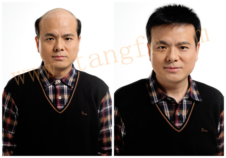 創(chuàng)始人唐利民 無(wú)痕增發(fā) 唐利民先生增發(fā)前后的效果
