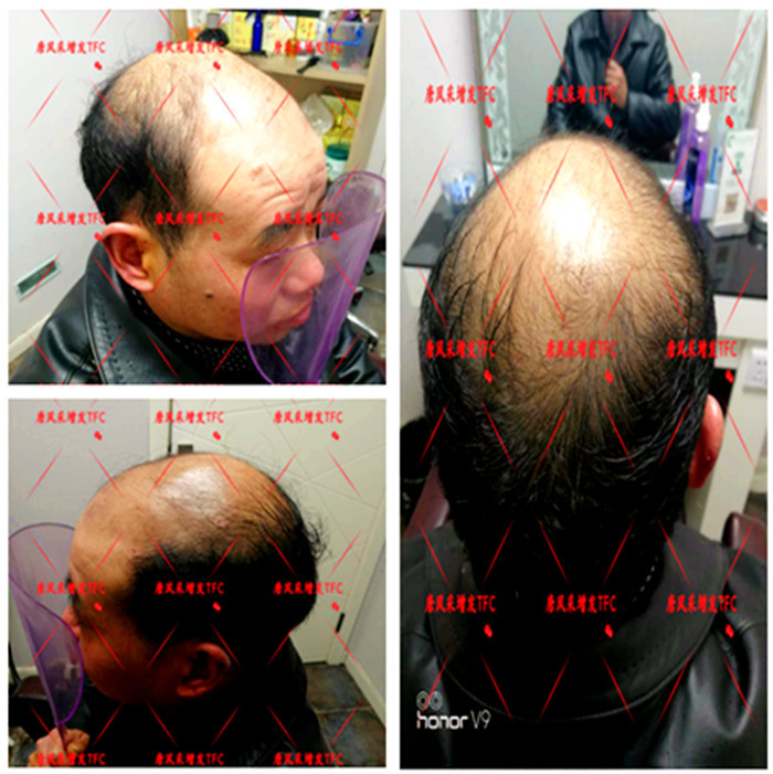 真人頭發(fā)假發(fā)套 唐風(fēng)采隱形增發(fā)客戶(hù)案例