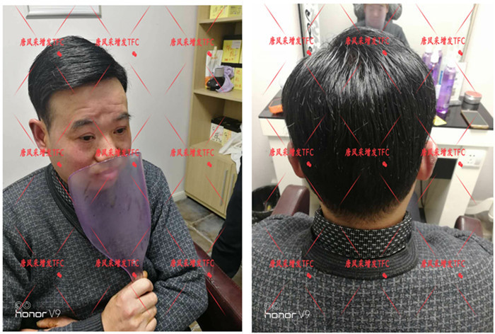 真人頭發(fā)假發(fā)套 唐風(fēng)采隱形增發(fā)客戶(hù)案例