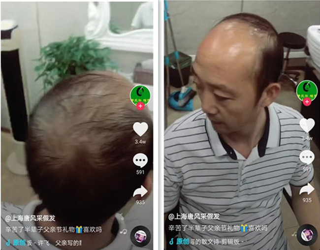 頭頂局部假發(fā) 唐風采客戶案例