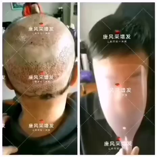 仿真頭皮假發(fā)價格 唐風采客戶王先生增發(fā)后