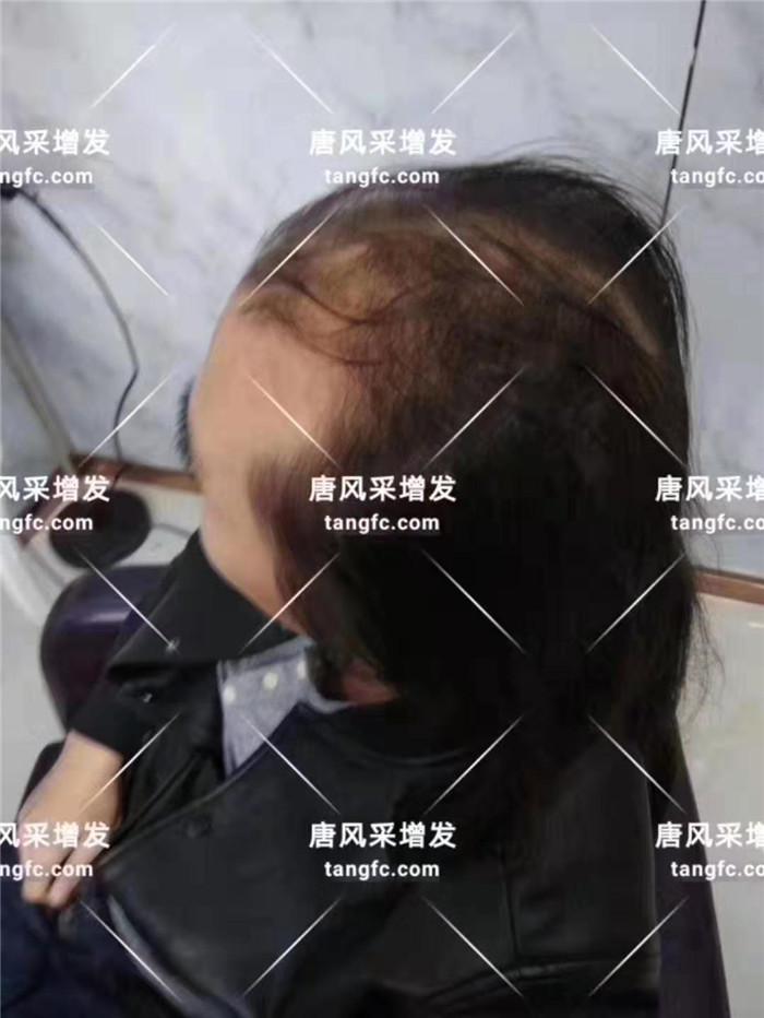 假發(fā)補(bǔ)發(fā)片專賣店 唐風(fēng)采客戶小Y增發(fā)前