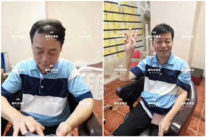 頭頂假發(fā)片 唐風采客戶李先生增發(fā)前后