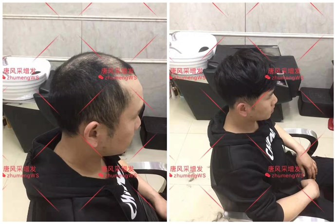 頭頂?shù)募侔l(fā)片 \