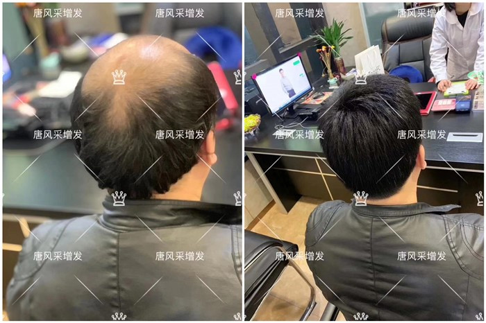 夏天帶假發(fā)熱嗎 \