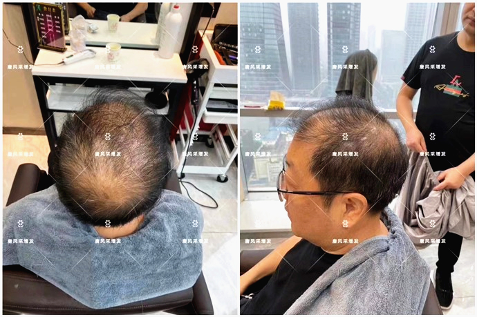 假發(fā)片頭頂補發(fā)片 \