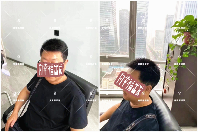 頭頂補發(fā)片 \