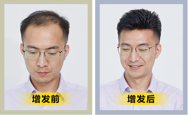 隱形假發(fā) \
