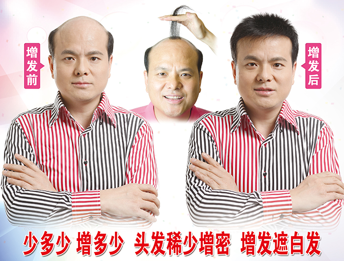 禿頂如何增發(fā) \