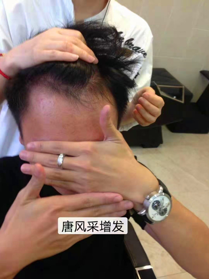 頭發(fā)太少做隱形增發(fā) \