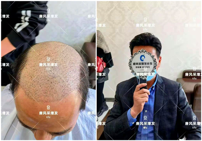 禿頂能移植頭發(fā)么 \