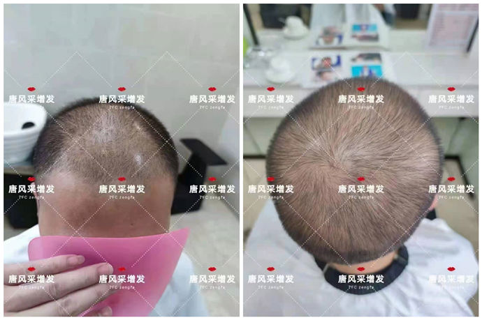 隱形男士假發(fā) \