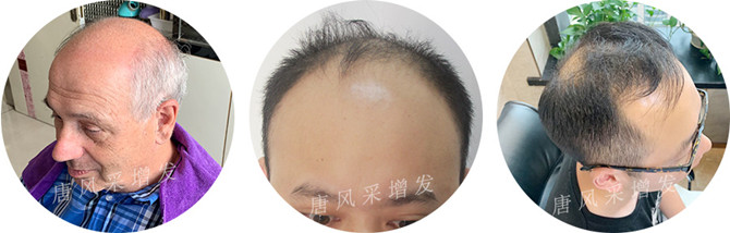 男士頭頂補發(fā) \