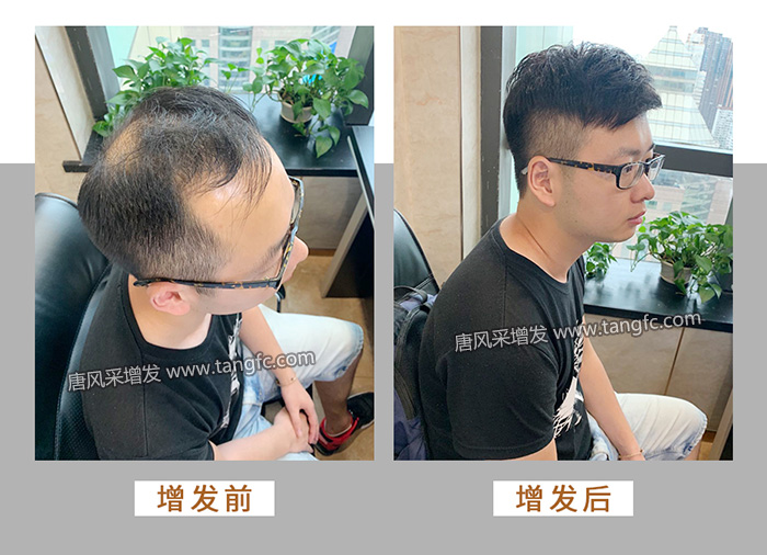 頭頂補發(fā)假發(fā)片 \