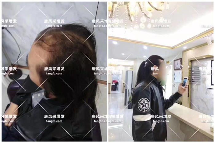 禿頂男士更適合哪種假發(fā) \