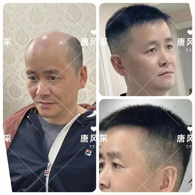 仿生長(zhǎng)無(wú)痕假發(fā) \