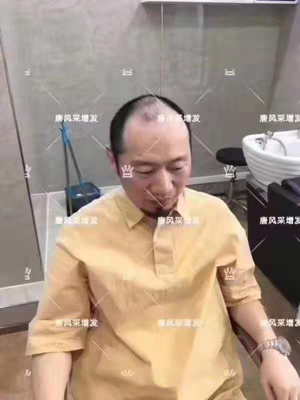 謝頂脫發(fā) \