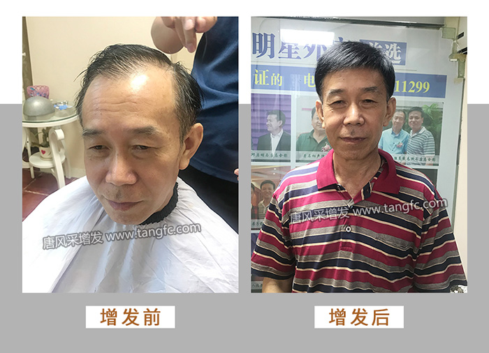 脂溢性脫發(fā) \