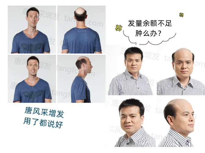 蘇州男士假發(fā)銷售量 \